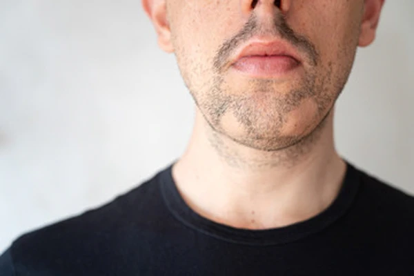 What Is Beard Alopecia? 2 What Is Beard Alopecia?