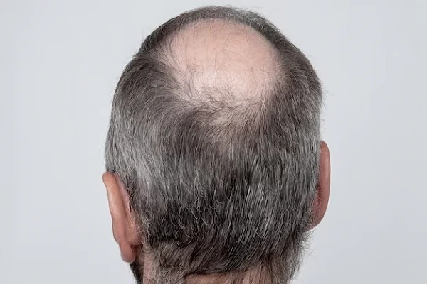 I am going bald, what can I do?