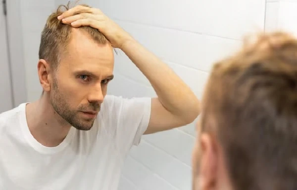 I am going bald, what can I do?