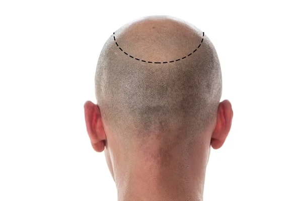Bald crown, what is the best solution? 4 Bald crown, what is the best solution?