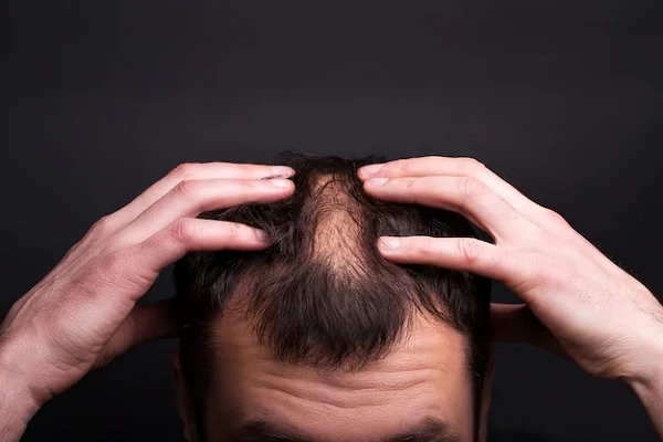 Hair transplant for bald people