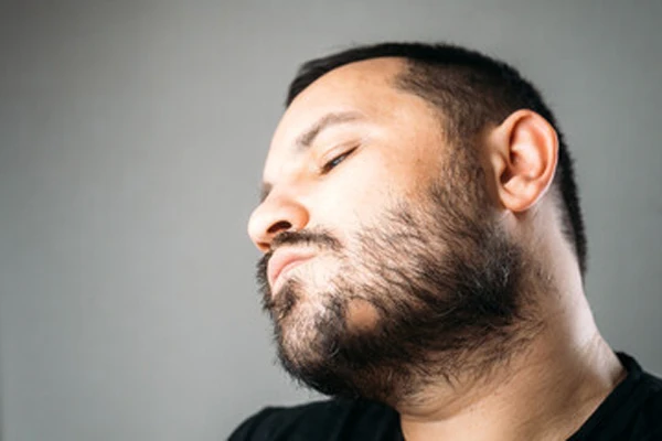 What Is Beard Alopecia? 1 What Is Beard Alopecia?