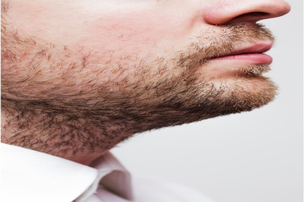 Beard Graft, Why Is It Done? 2 Beard Graft, Why Is It Done?
