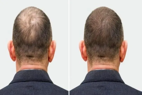 Which Method of Hair Transplant Is More Suitable for Thick Hair?