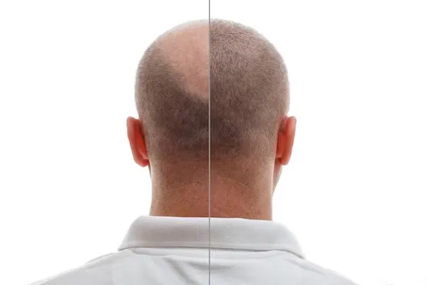 What is the best country for a hair transplant?