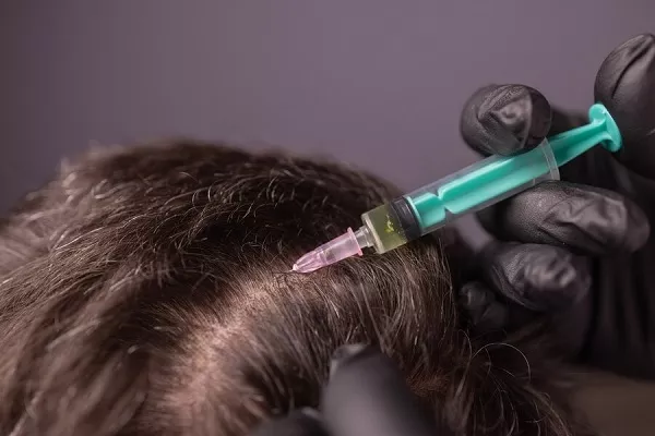 Capillary Infiltration, Does it stop Hair Loss?