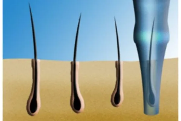 Turkey hair transplant: At the forefront of the world