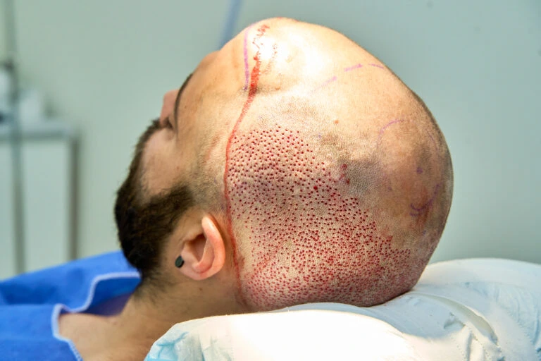 Who is the best hair transplant doctor in the world? 5 Who is the best hair transplant doctor in the world?