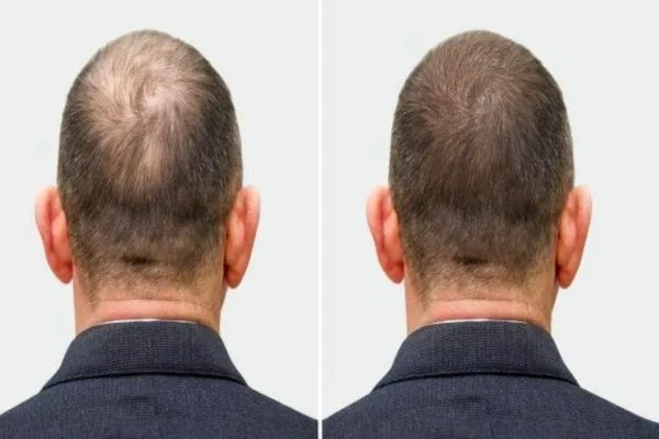 Hair transplant package in Turkey: Cost & results