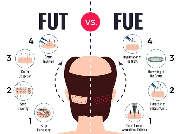 Best hair transplant in Turkey: Price updated 3 Best hair transplant in Turkey: Price updated