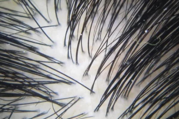 Tests to diagnose Alopecia 3 Tests to diagnose Alopecia