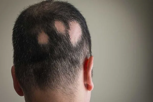 Tests to diagnose Alopecia 6 Tests to diagnose Alopecia