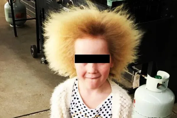 What is Uncombable Hair Syndrome: Treatment and more