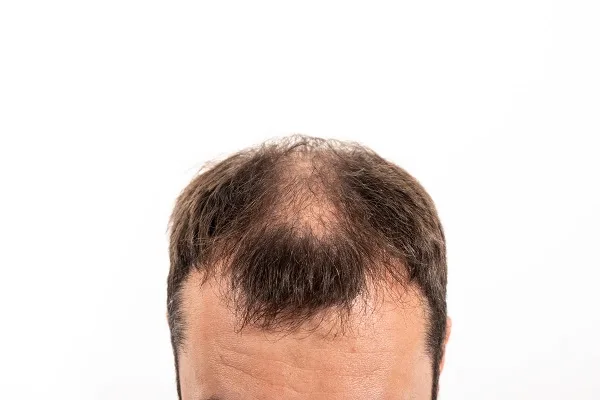 Top 5 Myths and Truths about Hair Loss and Treatments