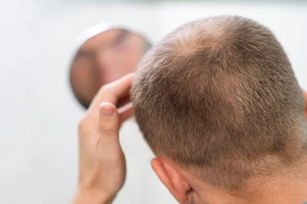 Is hair transplant price a good option in the UK?