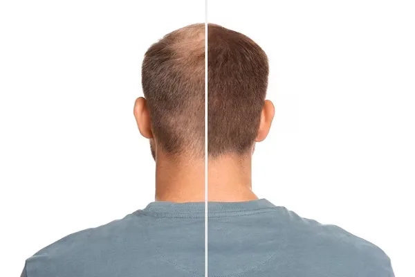 Results of hair transplant in Turkey