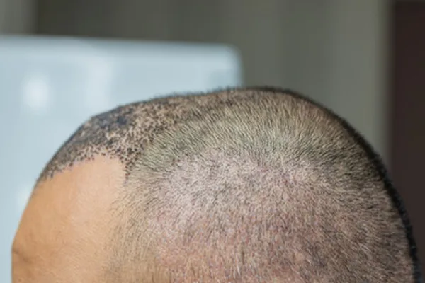 Cap after a hair transplant, is it good? 3 Cap after a hair transplant, is it good?