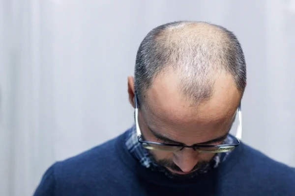 Bald crown, what is the best solution? 2 Bald crown, what is the best solution?