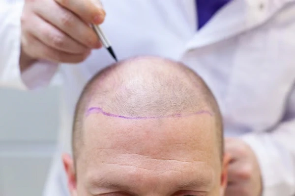 Is there a cure for baldness?