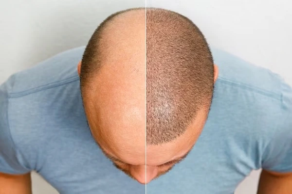 Tips after hair transplant: Medication and sports practice