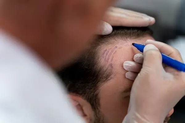 Tips after hair transplant: Medication and sports practice