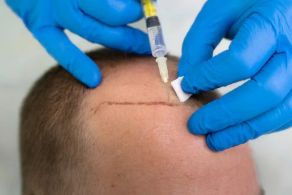 Does the Donor Area Grow Back After a Hair Transplant? 2 Does the Donor Area Grow Back After a Hair Transplant?