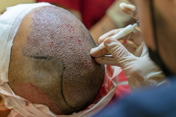 Trypophobia Due to Hair Transplant: Why Does It Occur? 2 Trypophobia Due to Hair Transplant: Why Does It Occur?