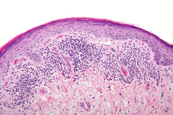 What is Lichen Planus and how can it damage the scalp? 4 What is Lichen Planus and how can it damage the scalp?