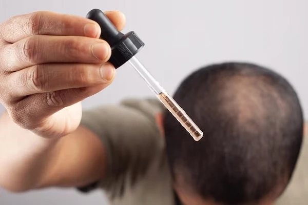 Minoxidil 5, what is it and how to use it to stop hair loss? 3 Minoxidil 5, what is it and how to use it to stop hair loss?