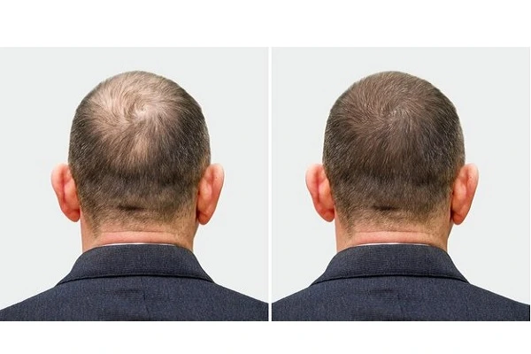 Results of hair transplant in Turkey