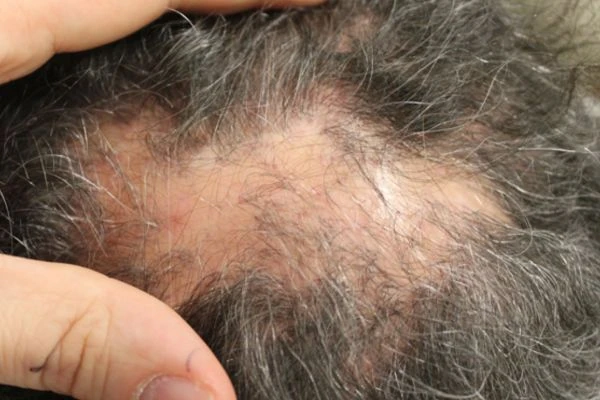 What is Lichen Planus and how can it damage the scalp? 1 What is Lichen Planus and how can it damage the scalp?