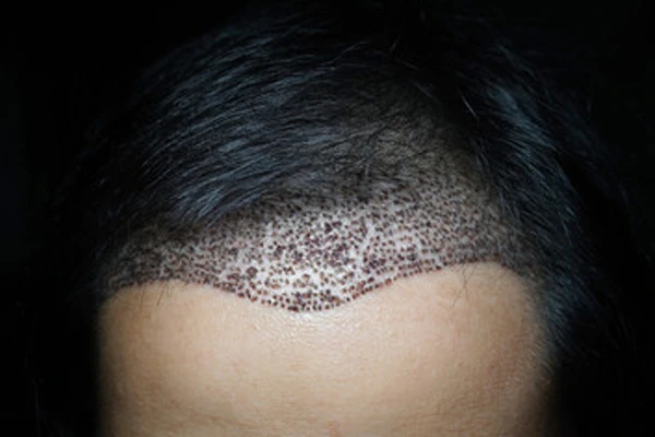 Pimples on the scalp after a hair trasplant