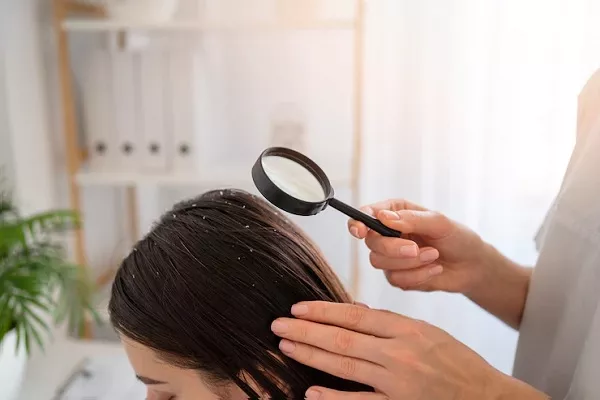 What is Seborrheic Dermatitis? DIY treatments 1 What is Seborrheic Dermatitis? DIY treatments