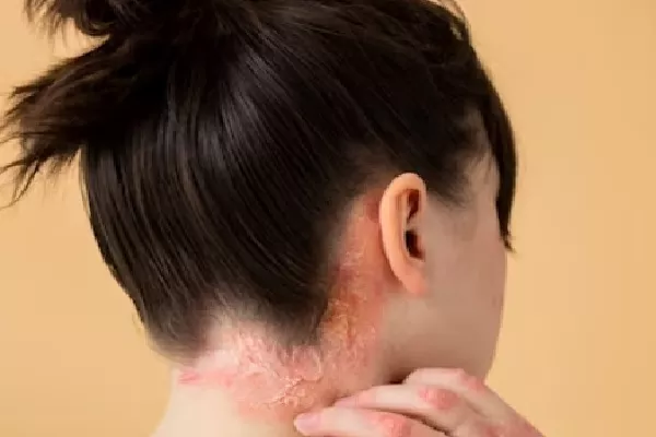 What is Seborrheic Dermatitis? DIY treatments 2 What is Seborrheic Dermatitis? DIY treatments