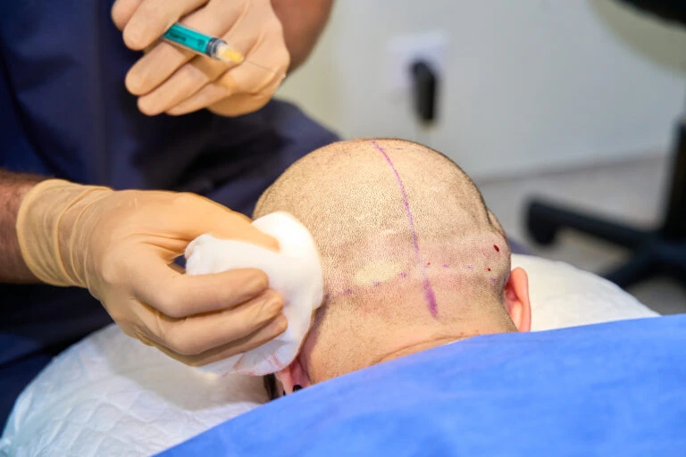 Who is the best hair transplant doctor in the world? 4 Who is the best hair transplant doctor in the world?
