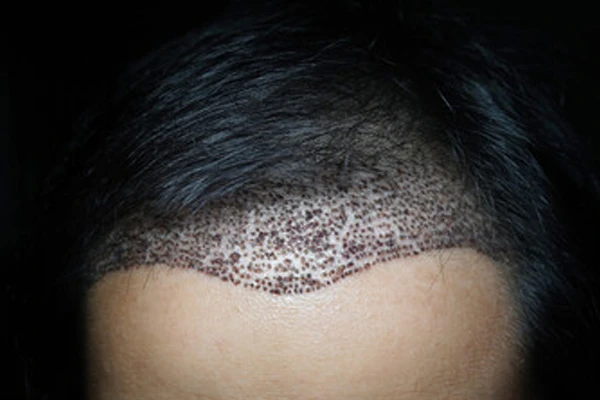 Trypophobia Due to Hair Transplant: Why Does It Occur? 3 Trypophobia Due to Hair Transplant: Why Does It Occur?
