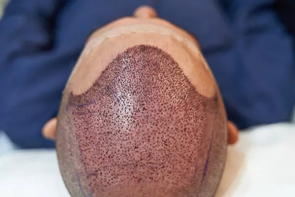 Hair Integration System, what does it consist of? 5 Hair Integration System, what does it consist of?