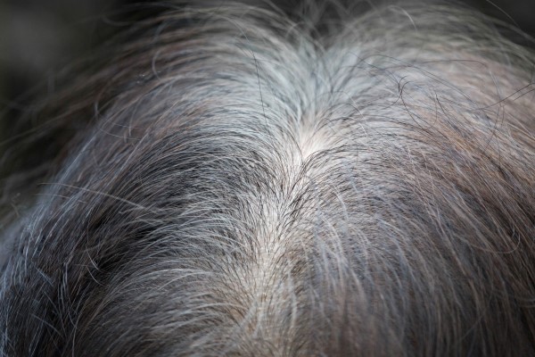 Hair Loss With White Roots, Is It Normal? 2 Hair Loss With White Roots, Is It Normal?