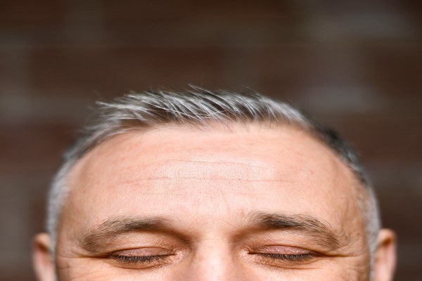 Hair Loss With White Roots, Is It Normal? 3 Hair Loss With White Roots, Is It Normal?