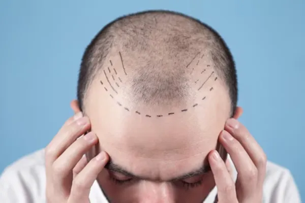 The FUE hair transplant, the best option against baldness