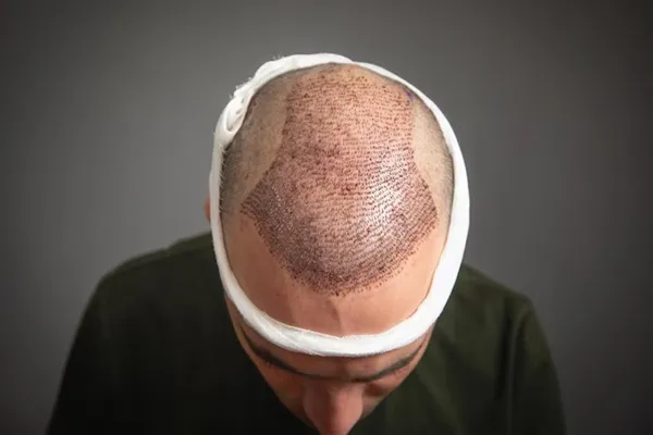 The FUE hair transplant, the best option against baldness