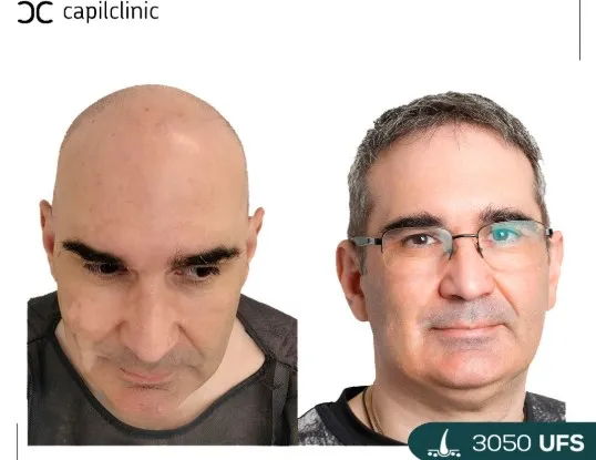 Steps to find the best hair transplant clinic in Turkey 3 Steps to find the best hair transplant clinic in Turkey