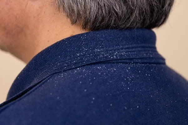Does dandruff affect hair transplants?