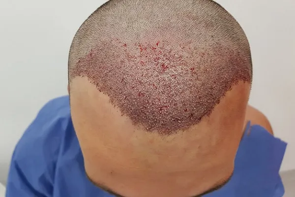Is hair transplant price a good option in the UK? 2 Is hair transplant price a good option in the UK?