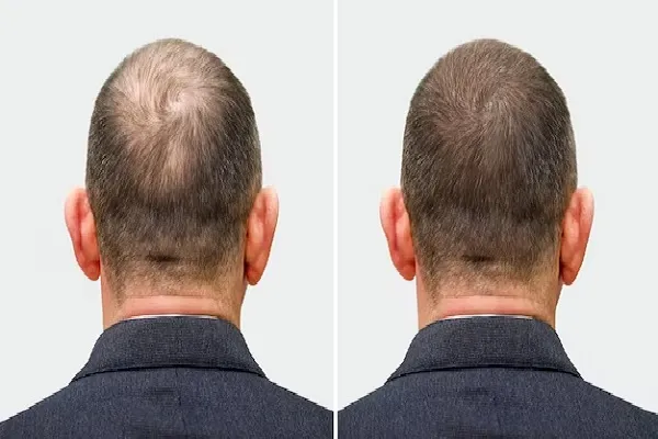 In addition to hair transplant cost in the UK, other factors must be taken into account