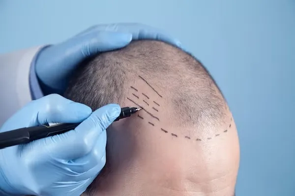 Is hair transplant price a good option in the UK? 3 Is hair transplant price a good option in the UK?