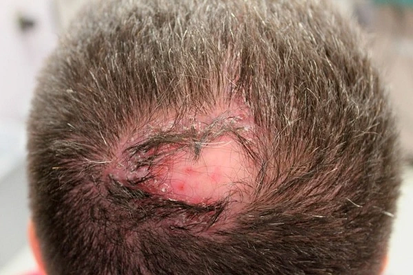 Effects of bad capillary implant and its solutions 3 Effects of bad capillary implant and its solutions
