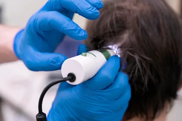 How to get the best hair transplant in London?