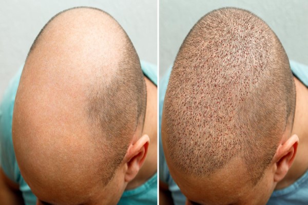 How much does a hair transplant cost in Spain? 1 How much does a hair transplant cost in Spain?