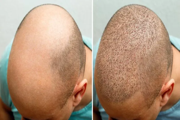In addition to hair transplant cost in the UK, other factors must be taken into account